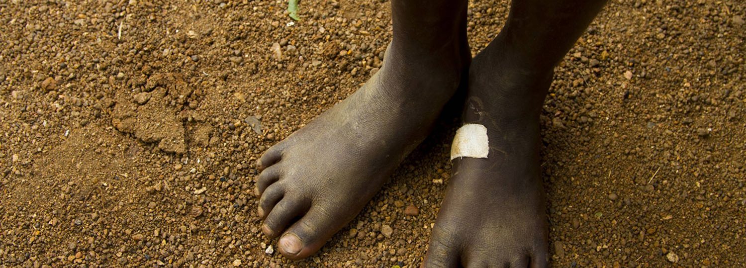 Child seeking treatment at a Guinea worm case containment center. Image credit: UNICEF.